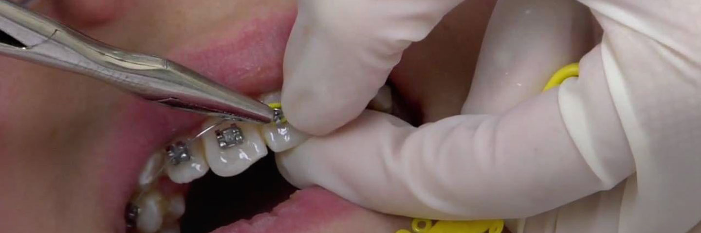 Зубы после брекетов: ТОП-5 процедур
