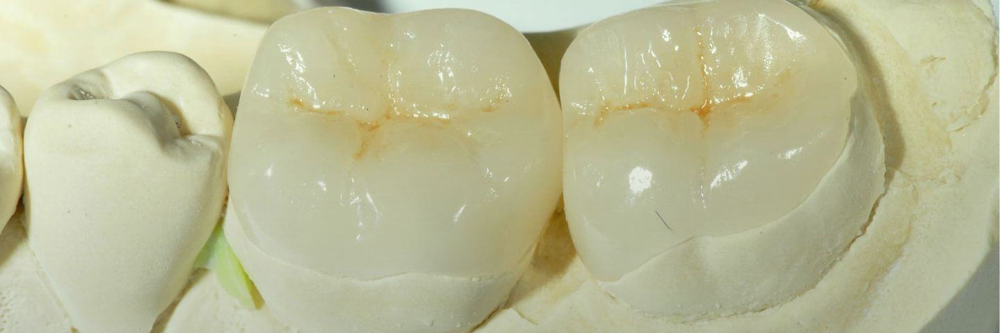 Возвращение «блудных» зубов