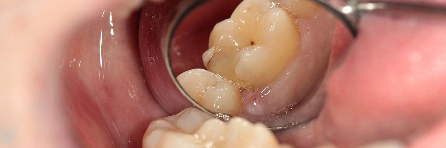 Молочные зубы и постоянные - отличия