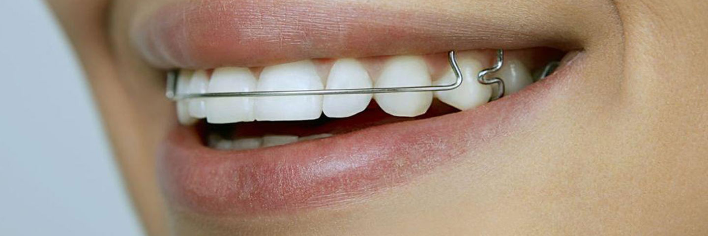 Съемная ортодонтическая пластинка - рекомендации по использованию