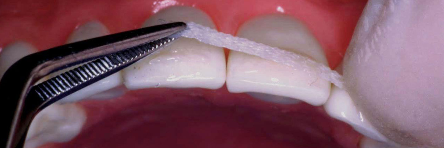 Шинирование зубов или операция «Спасение улыбки»