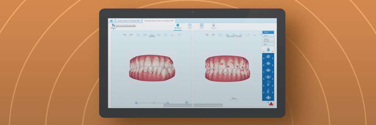 Ваши зубы в 3D с ClinCheck:
