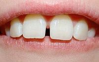 Промежутки между зубами - показание к лечению элайнерами